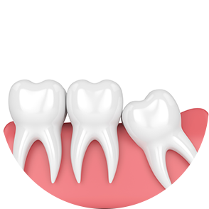 사랑니 발치 - 각도를 가지고